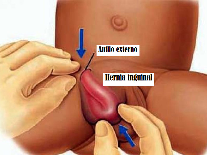 COMO CURAR HERNIA INGUINAL A LOS NIÑOS